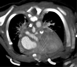 Stenosis of Left Main Pulmonary Artery - CTisus CT Scan