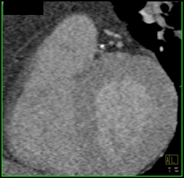 Narrowed LAD - CTisus CT Scan