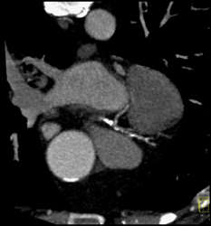 Calcified Cardiac Aa - CTisus CT Scan