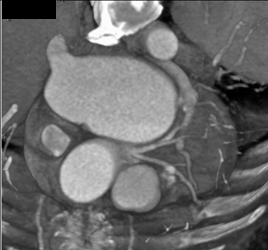 Normal Left Main Coronary Aa - CTisus CT Scan