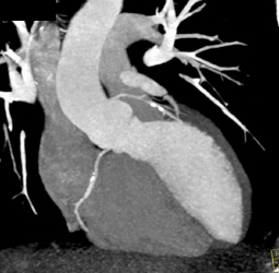 Calcified Plaque in LAD and RCA - CTisus CT Scan