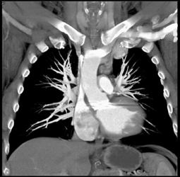 Unusual Repair of Coarctation of the Aorta - CTisus CT Scan