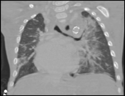 Stents in Pulmonary Outflow Tracks - CTisus CT Scan