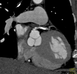 Diseased LAD and RCA - CTisus CT Scan