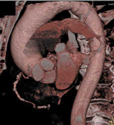 Stenosis in RCA - CTisus CT Scan