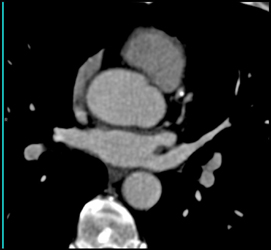 Dilated Aortic Root With Calcification in the LAD - CTisus CT Scan