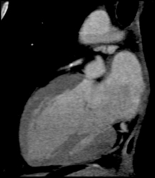 Diseased LAD With 50% Stenosis - CTisus CT Scan