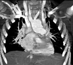 Double Outlet Right Ventricle - CTisus CT Scan