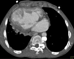 Situs Inversus With Prominent Azygos Vein - CTisus CT Scan