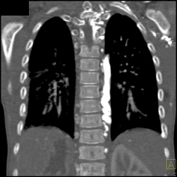 Prominent Azygos Vein - CTisus CT Scan