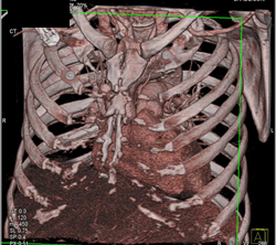 Patent Coronary Aa Grafts - CTisus CT Scan