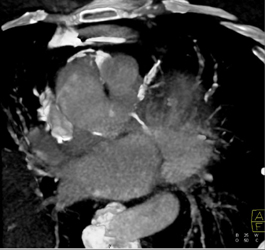 Extensive Coronary Aa Calcification - CTisus CT Scan