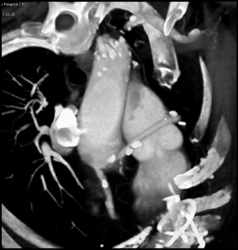 Diseased LAD and Circumflex of RCA - CTisus CT Scan