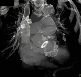 Patent Saphenous Graft and Aortic Valve Replacement (AVR) - CTisus CT Scan