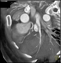 Patent LAD - CTisus CT Scan