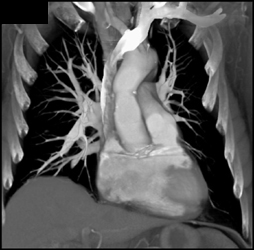 Aortic Valve With Graft - CTisus CT Scan