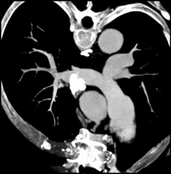 Dilated Left Main Coronary Aa - CTisus CT Scan