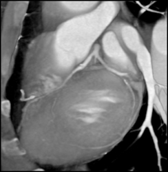 Plaque in LAD and Circumflex - CTisus CT Scan