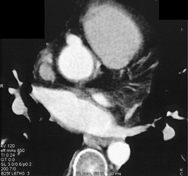 RCA Aneurysmal Dilatation - CTisus CT Scan