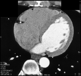 Patent RCA - CTisus CT Scan