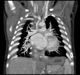 Reconstructed Arch for Single Ventricle - CTisus CT Scan