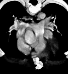 Repair of Transposition of the Great Vessels - CTisus CT Scan