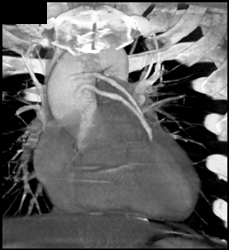 Saphaneous Bypass Grafts - CTisus CT Scan