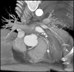 >80% Stenosis Circumflex at Origin - CTisus CT Scan