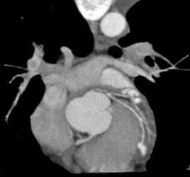 Stenosis Circumflex - CTisus CT Scan