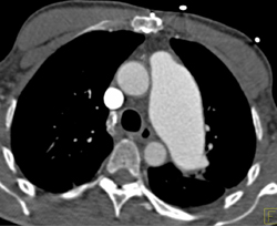 Pulmonary Stenosis - CTisus CT Scan