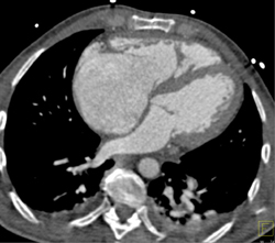 Enlarged Right Ventricle - CTisus CT Scan