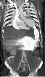 Left Ventricular Assist Device (LVAD) With Anastomosis - CTisus CT Scan