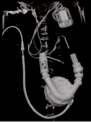 Left Ventricular Assist Device (LVAD) With Artifact Reduction - CTisus CT Scan