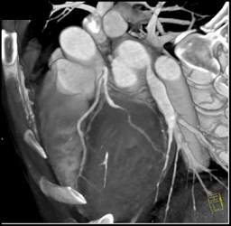 Stenosis of Circumflex Aa Coronary - CTisus CT Scan