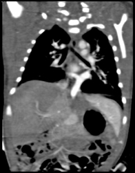 Anomalous Pulmonary Venous Return- APVR - CTisus CT Scan