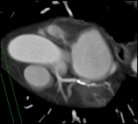 Circumflex and LAD Disease - CTisus CT Scan