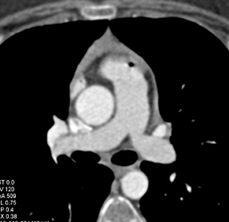 Air in Pulmonary Artery Due to Technical Error - CTisus CT Scan