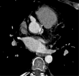 Aortic Valve Replacement (AVR) With Aneurysm of Right Coronary Artery - CTisus CT Scan