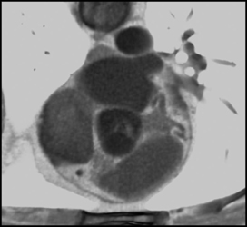 Thickened Aortic Valve Leaflet - CTisus CT Scan