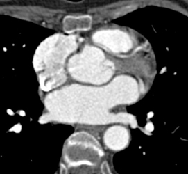 Aberrant Left Main Coronary Aa Off Right Coronary Artery - CTisus CT Scan