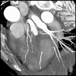 Signified Soft Plaque in LAD With Low Calcified Score - CTisus CT Scan