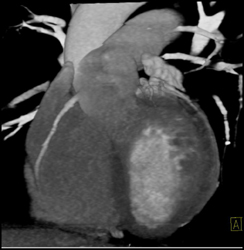 Selection of Right Portion of R-r Interval Is Critical to Not Create Lesions - CTisus CT Scan