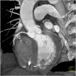 Normal CTA in 3D VRT - CTisus CT Scan