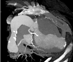 Left Ventricular Aneurysm-sp Infarct - CTisus CT Scan