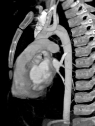 Incomplete Double Aortic Arch - CTisus CT Scan