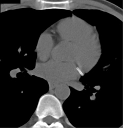 Stent in Circumflex Coronary Aa - CTisus CT Scan