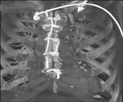 Patent Left Internal Mammary Artery (LIMA) - CTisus CT Scan