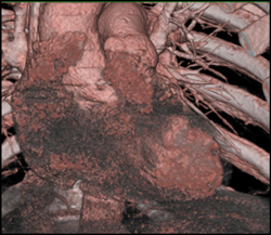 The Importance of the Right Phase of Reconstruction Is Critical for Eliminating Cardiac Motion - CTisus CT Scan