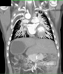 Right Aortic Arch With Situs Inversus - CTisus CT Scan