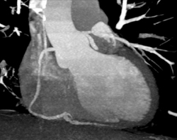 RCA With Minimal Plaque - CTisus CT Scan